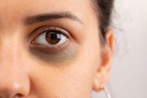 Augenringe entfernen: 5 effektive Tipps zur Behandlung Augenringe entfernen