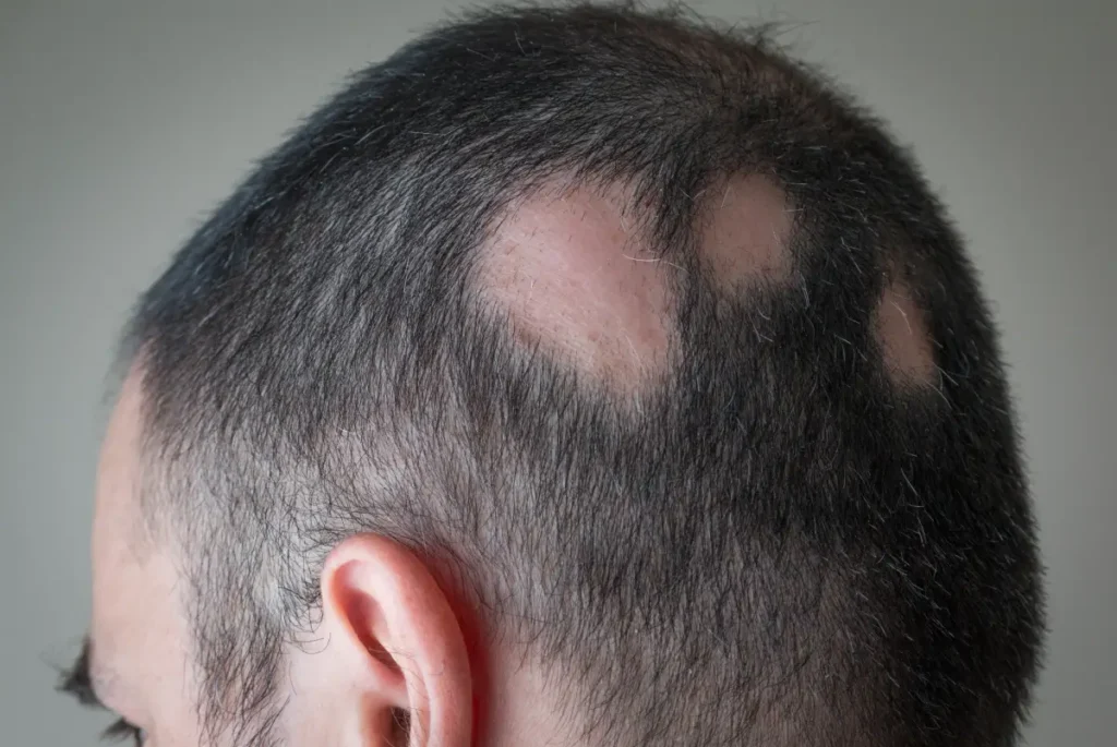 Kreisrunder Haarausfall