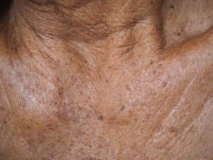 Pigmentflecken entfernen: Verfärbungen mit Hausmitteln aufhellen Pigmentflecken entfernen